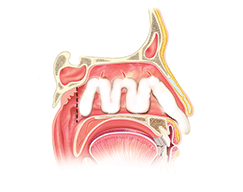 ALGOSTÉRIL mèche ronde dans la fosse nasale