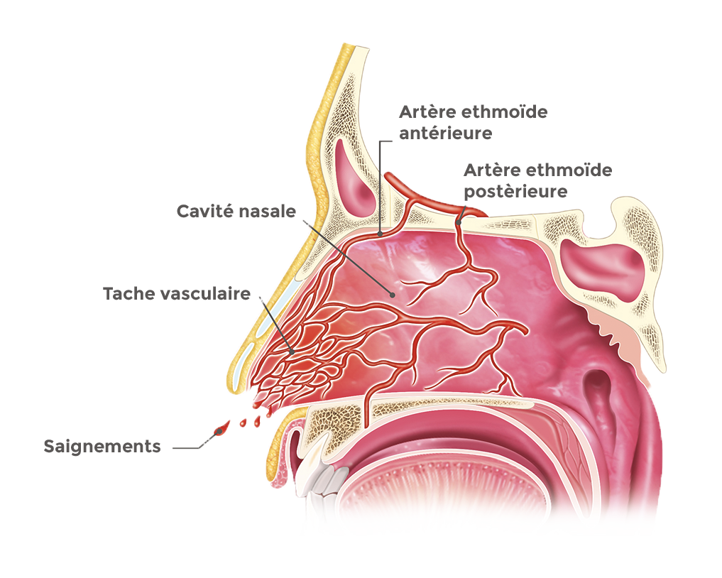 Epistaxis saignement de nez Coupe anatomique de la cavité nasale